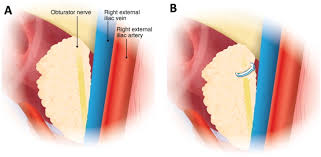Image result for Obturator Nerve Compression