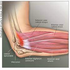 Tennis elbow refers to a degeneration of these tendons because of repetitive use. Traditional Conservative Treatments For Tennis Elbow Hss