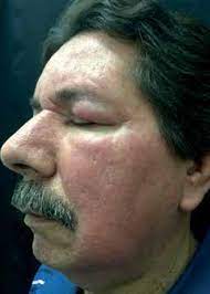 A statistical evaluation of 241 reported. Scielo Brasil Morbihan Disease A Therapeutic Challenge Morbihan Disease A Therapeutic Challenge