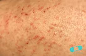 Ett rött utslag på barnets ansikte kan verka som en reaktion på medicinering eller vaccination. Nar Semestern Gar Fel Sex Hudutslag Manniskor Fatt Utomlands