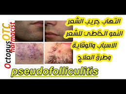 التهاب بصيلات الشعر التهاب جريب الشعر حبوب حول بصيلات الشعر فى الوجه الذقن المناطق الحساسة والجسم Youtube