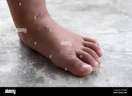 Dermatitis Atopica Picor Del Pie Del Bebe Cerrar Herida Infectada Herida Abierta En La Pierna Izquierda Fotografia De Stock Alamy