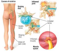 Muscles of the low back. Sciatica Guide Causes Symptoms And Treatment Options