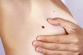 The skin is made up of three layers, including the epidermis, which is the top layer of the skin. Mole Or Skin Tag How To Tell The Difference