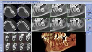 We did not find results for: 9 Important Facts About Wisdom Teeth And Tooth Removal Webdento