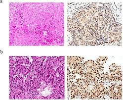 Maybe you would like to learn more about one of these? Questioning The Prognostic Role Of Bap 1 Immunohistochemistry In Malignant Pleural Mesothelioma A Single Center Experience With Systematic Review And Meta Analysis Lung Cancer