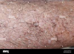Image result for liver spots on legs