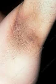 Acanthosis nigricans in the armpit - Stock Image - C013/1055 - Science Photo Library