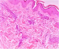 Pathology Outlines Behcet Disease