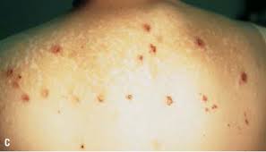 Image result for Neurotic Excoriation