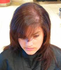 7 Natural Home Remedies To Stop Hair Loss Online Bee Pcos Hair Loss Pcos Hair Loss Treatment Hair Loss Cure