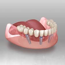 How long do titanium dental implants last? All On 4 Dental Implants Santa Fe Nm Taos Nm Los Alamos Nm Oral Surgery And Dental Implant Center Of Santa Fe