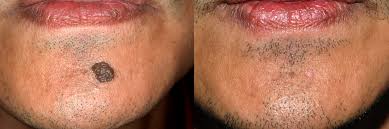 Remove Moles & Scars with a Non-Invasive Mole Removal Surgery