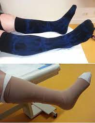 Offenes Bein Ulcus Cruris Ursachen Diagnose Therapien Orthinform
