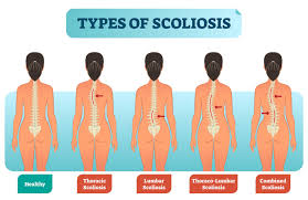 Bone on the top back of neck, right under skull. Scoliosis Symptoms