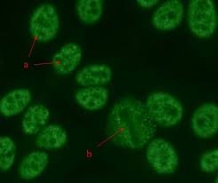 Image result for ANA Staining Pattern