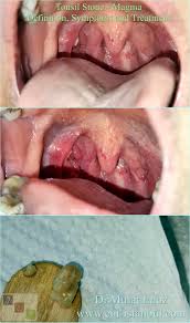 Image result for Tonsillolith