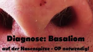 Diagnose Basaliom Heilung Durch Schwarze Salbe Youtube