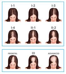 The causes of hair loss in men—and treatments. Female Thinning Hair Hair Loss Pattern Baldness In Women