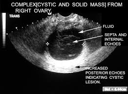 Even if chemotherapy results in a complete clinical response (ie, normal physical examination, normal serum ca 125, negative ct scan of the abdomen and. Ct Scan Vs Ultrasound Ovarian Cancer Ct Scan Machine