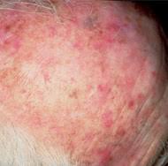 Find facts and statistics for reporting about skin cancer. Actinic Keratosis Warning Signs And Images The Skin Cancer Foundation
