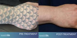 However, the treatment is very short an d area can be numbed. The 1 Choice For Safe Effective Laser Tattoo Removal