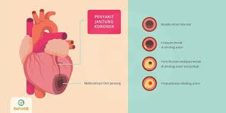 Selain sakit pundak dan leher yang bisa mengganggu aktivitas, nyeri bahu sebelah kanan juga tidak boleh disepelekan. Penyakit Jantung Koroner Tanda Dan Gejala Penyebab Cara Mengobati Cara Mencegah
