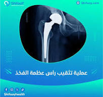 ‫عملية تثقيب رأس عظمة الفخذ - مركز شفائي‬‎
