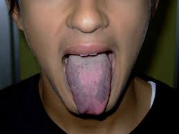 Image result for black tongue symptoms