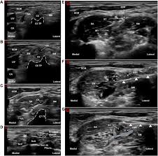 Image result for Superior Trunk Block