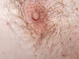 Image result for pubic lice symptoms