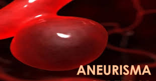 Afinal qualquer dilatação nas artérias com medição superior a três centímetros é chamada desta forma. Team Phoenix Aneurisma Cerebral Brain Aneurysm