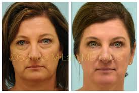 This 51 Year Old Woman Is Shown Before And After Upper Blepharoplasty Upper Eyelid Surgery Pe Eyelid Surgery Recovery Blepharoplasty Recovery Facial Fillers