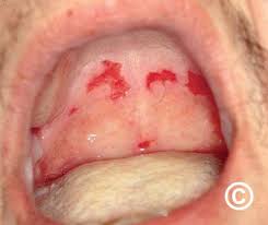 Image result for Physical injury red spots roof of mouth