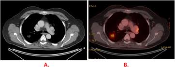 The scanning table has a maximum weight capacity of 425 to 450 pounds, while the gantry has a diameter of only 27.5 inches. The Added Value Of18f Fdg Pet Ct In Staging Non Small Cell Lung Cancer Egyptian Journal Of Radiology And Nuclear Medicine Full Text