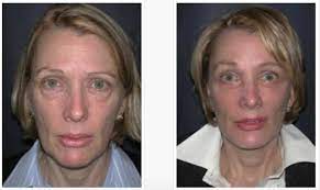 Maybe you would like to learn more about one of these? Blepharoplasty Does Insurance Cover Eyelid Lifts Jones Ent And Facial Plastic Surgery
