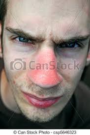 Der effekt zur schleimlösung beruht auf der verengung der blutgefäße in der nase sowie der entzündungshemmung. Nasenbrand Dieser Ungluckliche Junge Mann Hat Einen Schlimmen Roten Sonnenbrand Auf Der Nase Und Die Rote Haut Schalt Jetzt Canstock