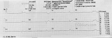 Image result for Pulseless Electrical Activity