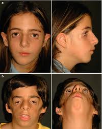 A group of symptoms that collectively indicate or characterize a disease, disorder, or other condition considered abnormal. Treacher Collins Franceschetti Syndrome Springerlink