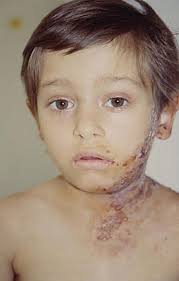 Image result for shingles in children
