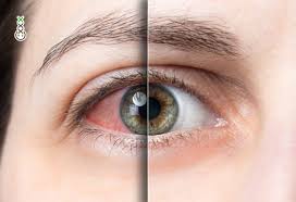 Why Your Eyes Turn Red After Smoking Cannabis Boerejongens