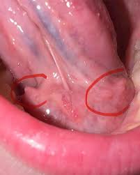 Image result for papillomavirus tongue)