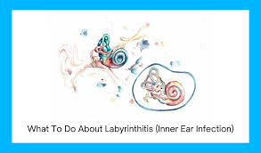 Image result for Bacterial Labyrinthitis