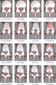 It is a result of disorganized new cortical bone formation after excessive osteoclastic activity causes the resorption of normal bone. Automatic Spine Segmentation From Ct Images Using Convolutional Neural Network Via Redundant Generation Of Class Labels Sciencedirect