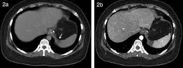 Aquilo que ocasiona bloqueio, entupimento ou obstrução forma derivada de enfartar, en + farto + ar. Infarto Esplenico Diagnosticado Por Tc Se Observa Lesion Esplenica Download Scientific Diagram