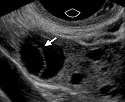 How to transabdominal view of the female pelvis with ultrasound spanish. Imaging Of The Female Pelvis Through The Life Cycle Radiographics