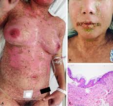 N engl j med 1995; Urogynecologic Complications In Stevens Johnson Syndrome And Toxic Epidermal Necrolysis Presentation Of A Case And Recommendations For Management Jaad Case Reports