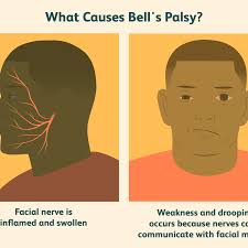 Symptoms develop suddenly, usually within a couple of days, and can range from mild weakness to total paralysis of face muscles. Bell S Palsy Diagnosis And Chance Of Recovery