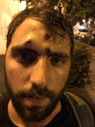 Update information for ainara tiefenthäler ». Ainara Tiefenthaler On Twitter Esta Foto Se Hizo Viral Muestra A Joshua Hernandez Un Contador De 23 Anos De San Juan Que Resulto Herido En La Cara Por Tres Impactos De Balines