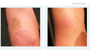 Check spelling or type a new query. Covid Arm Some Develop Delayed Skin Reaction After Moderna Vaccine Shot Abc7 Los Angeles